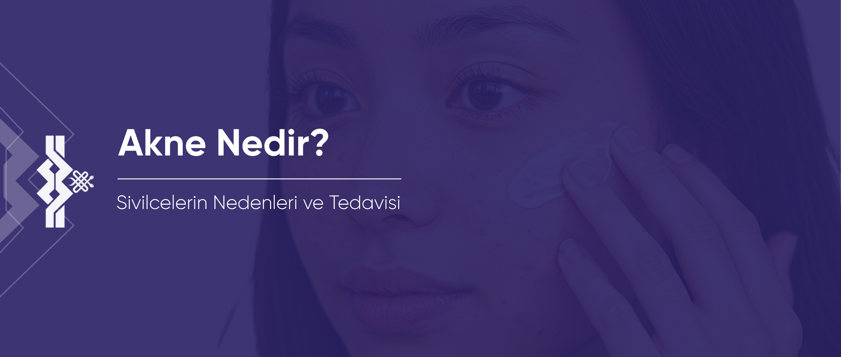 Akne Nedir? Sivilcelerin Nedenleri ve Tedavisi